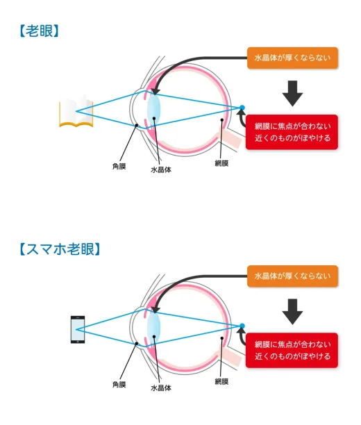 老眼・スマホ老眼の原因