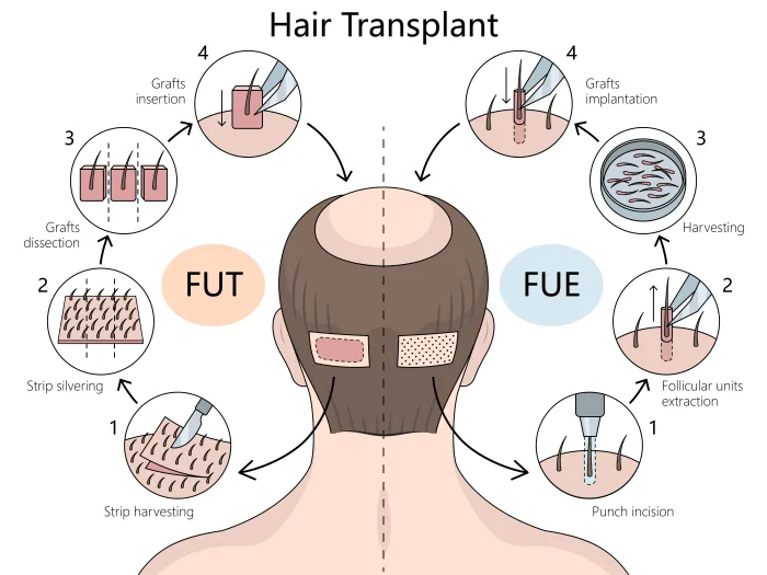 自毛植毛／hair transplant