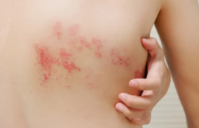 帯状疱疹の初期症状として、神経痛のような皮膚のピリピリ感やチクチク感があらわれます。