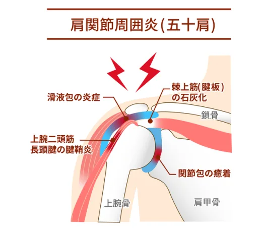 四十肩・五十肩（肩関節周囲炎）とは？